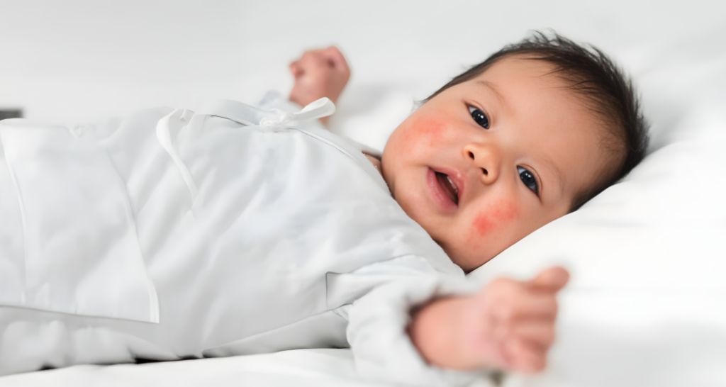 Eczema treatment in Dubai and long-term skin care for children.