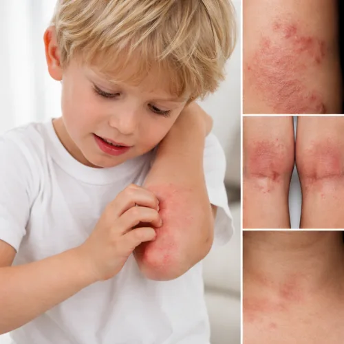 Eczema (Atopic Dermatitis) treatment