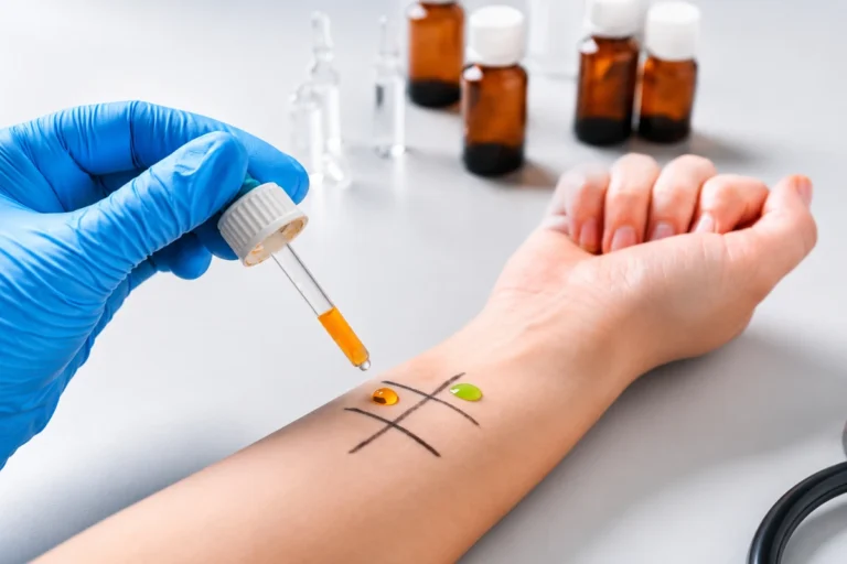 Blog 4 Skin testing for suspected medication allergy