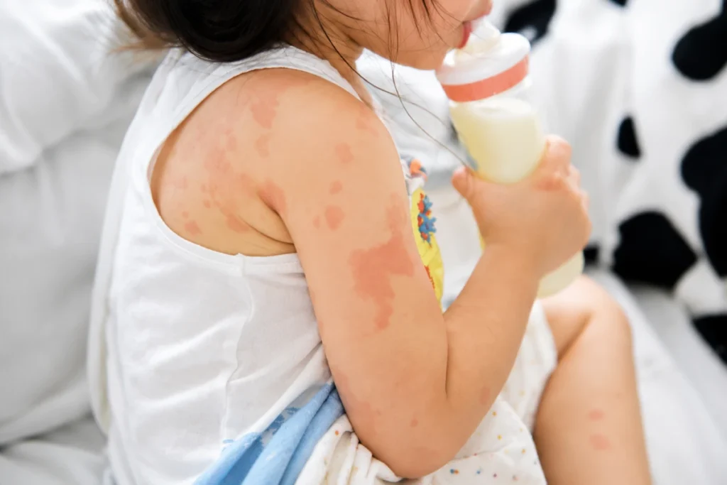 Allergy Testing for Eczema: When Is It Recommended? 2 A young child with visible red hives and allergic skin rash on her shoulder and arm holding a milk bottle.