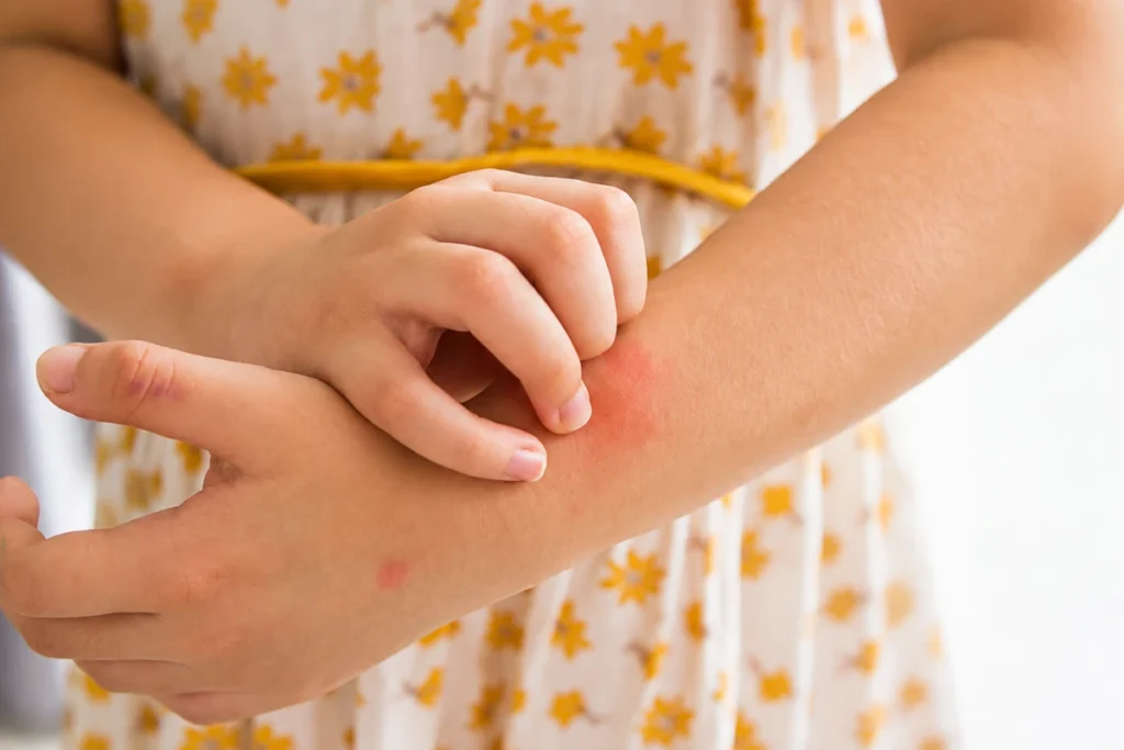 Is Oral Immunotherapy Safe for Children? 1 Close-up of a child wearing a floral dress scratching a red, irritated allergic skin rash on her forearm.