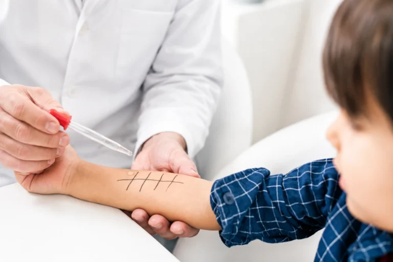Blog 2 A doctor using a dropper to apply an allergen liquid extract onto a child's forearm marked with a testing grid.