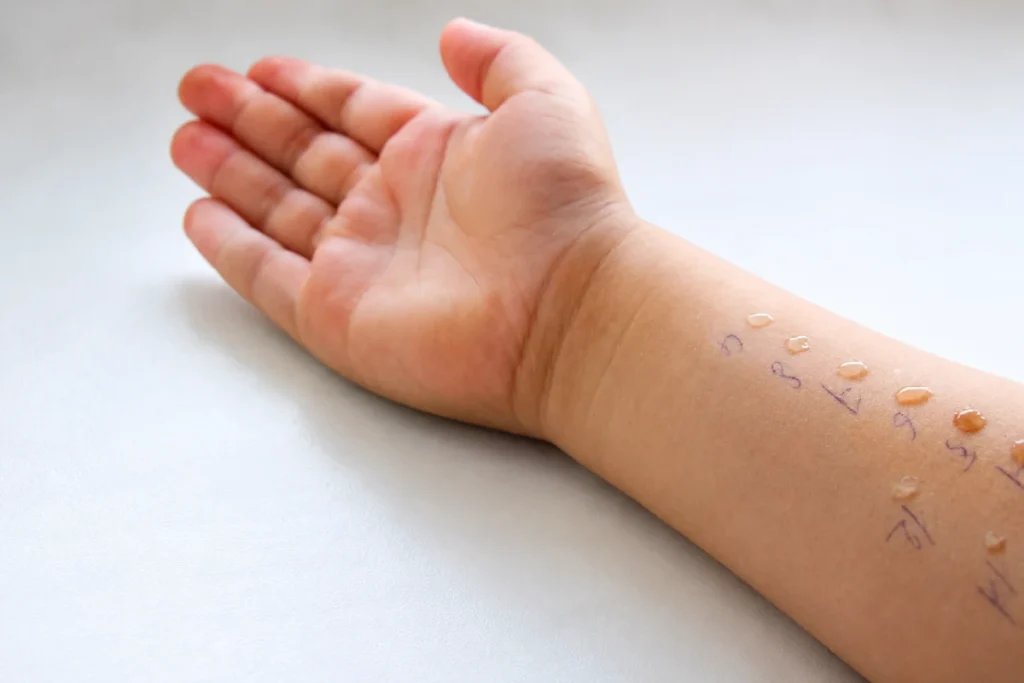 Allergy Testing for Eczema: When Is It Recommended? 1 A child's inner forearm marked with numbered grid lines showing small allergen droplets for skin-prick allergy testing.
