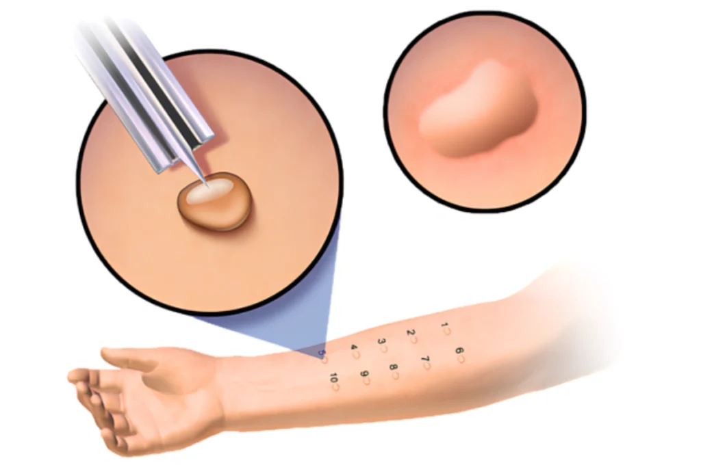 A detailed diagram of a skin prick allergy test on a child's forearm showing numbered test sites and a close-up of a positive wheal reaction.