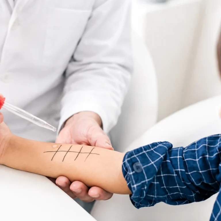 A doctor using a dropper to apply an allergen liquid extract onto a child's forearm marked with a testing grid.
